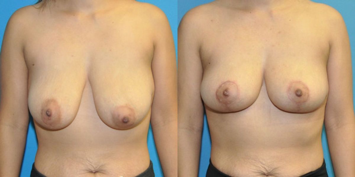 Breast Lift #21 - Before and After