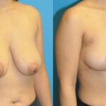 Breast Lift #21 - Before and After