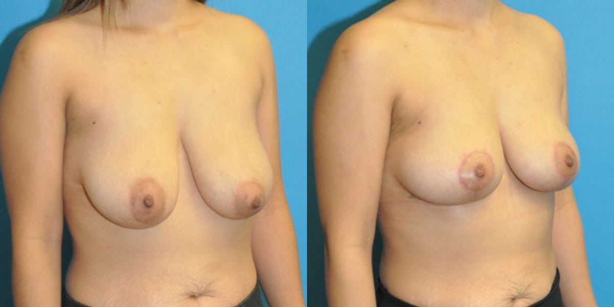 Breast Lift #21 - Before and After