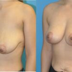 Breast Lift #21 - Before and After