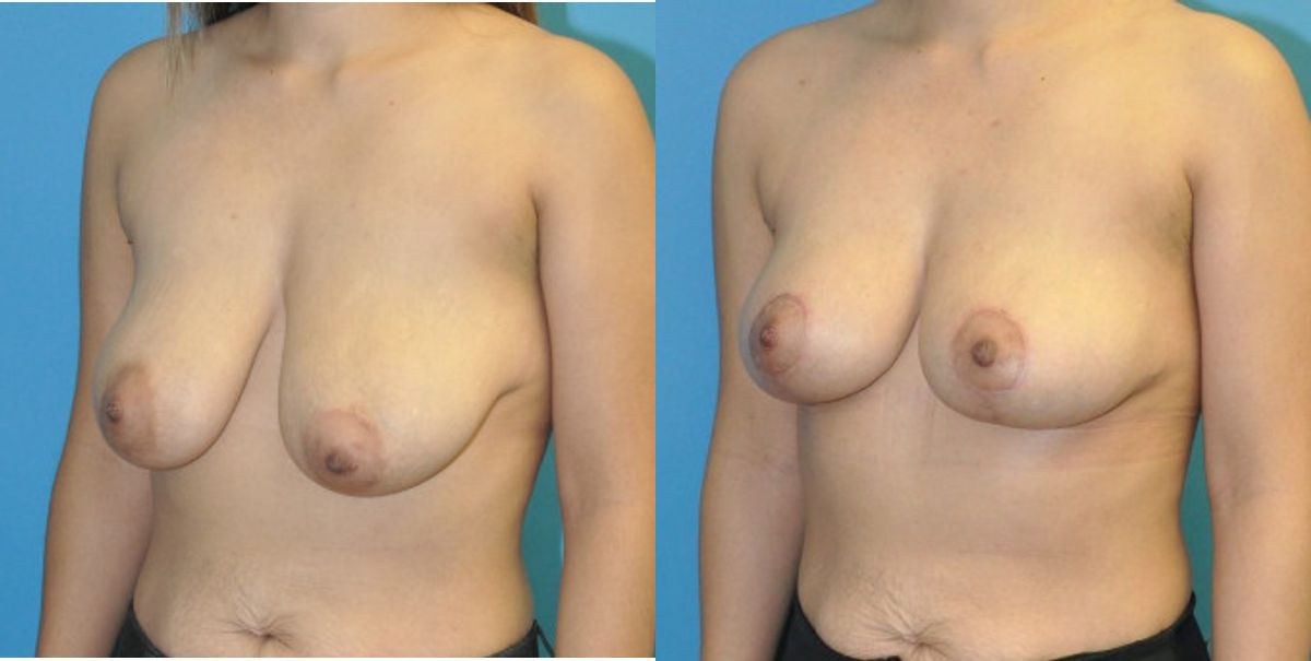 Breast Lift #21 - Before and After