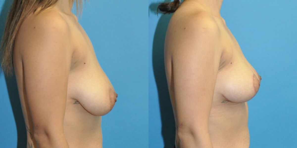 Breast Lift #21 - Before and After