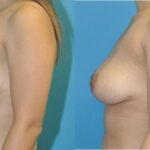 Breast Lift #21 - Before and After