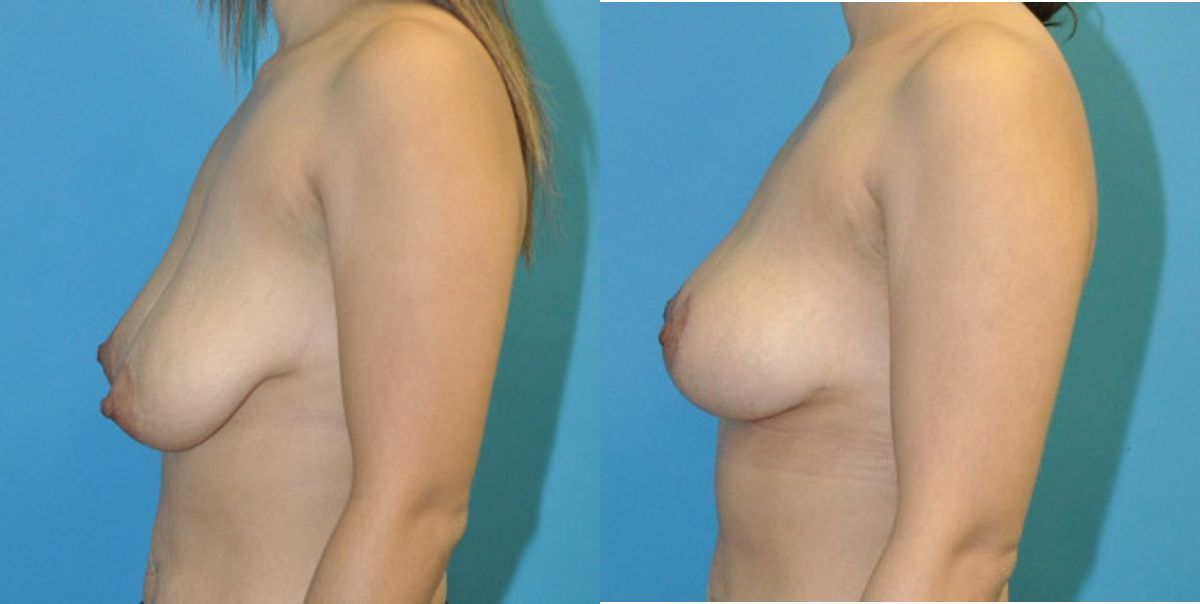 Breast Lift #21 - Before and After