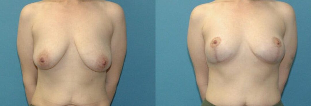 Breast Lift #22