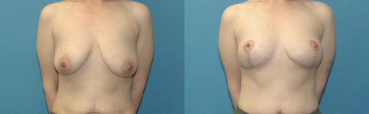 Breast Lift #22 - Before and After