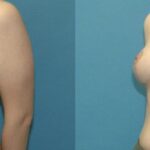 Breast Lift #22 - Before and After