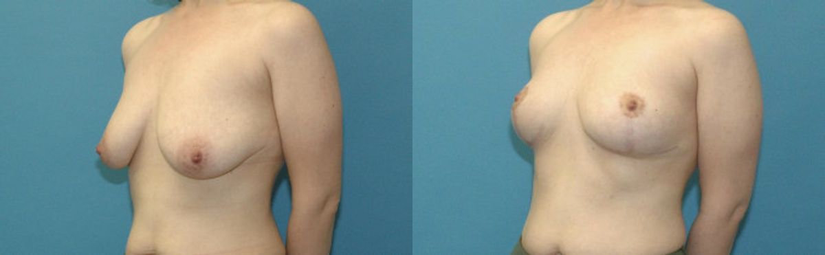 Breast Lift #22 - Before and After