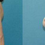 Breast Lift #22 - Before and After