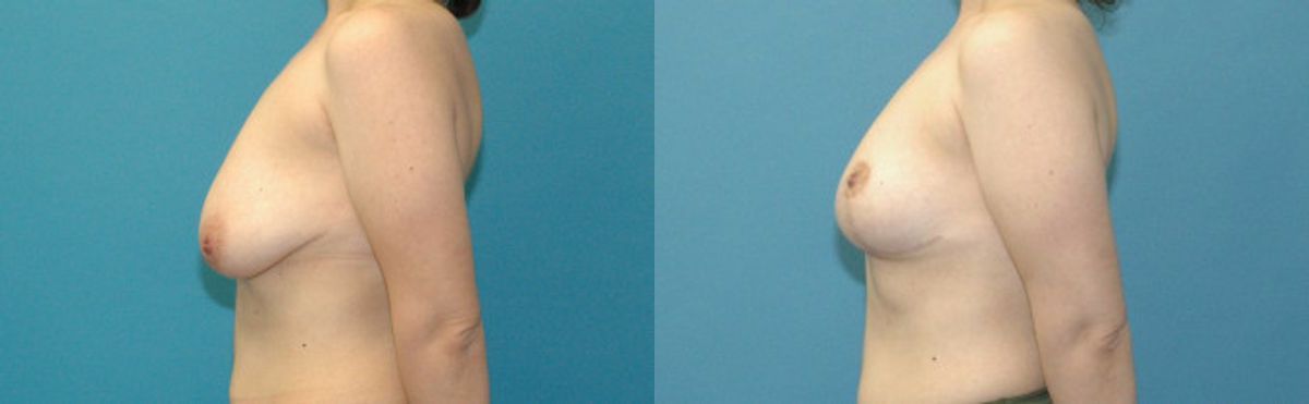 Breast Lift #22 - Before and After