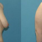 Breast Lift #22 - Before and After