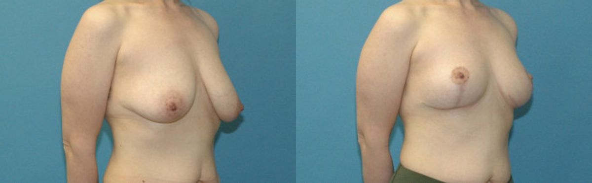 Breast Lift #22 - Before and After