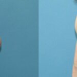 Breast Lift #22 - Before and After