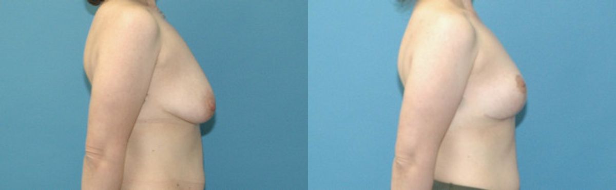 Breast Lift #22 - Before and After