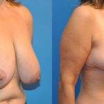 Breast Reduction #1 - Before and After