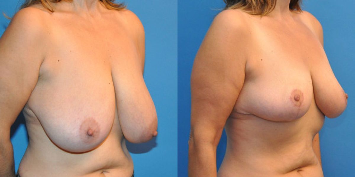 Breast Reduction #1 - Before and After