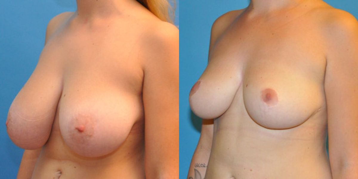 Breast Reduction #2 - Before and After