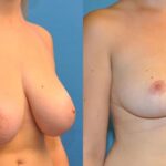 Breast Reduction #2 - Before and After