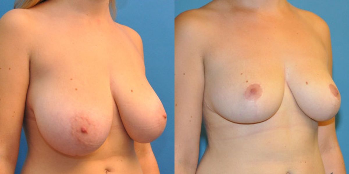 Breast Reduction #2 - Before and After