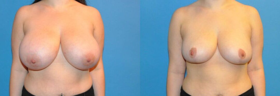 Breast Reduction #3