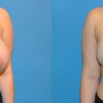 Breast Reduction #3 - Before and After