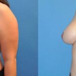 Breast Reduction #3 - Before and After