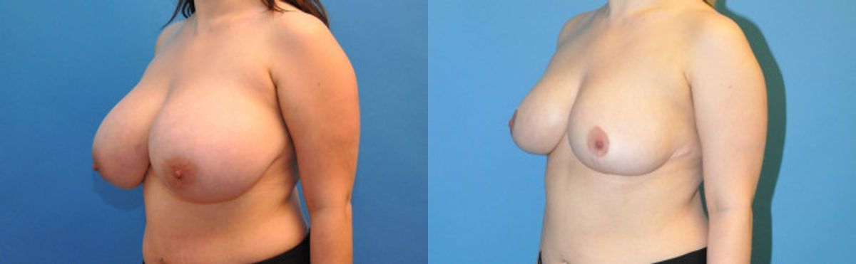 Breast Reduction #3 - Before and After