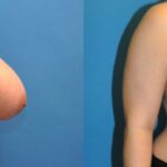 Breast Reduction #3 - Before and After