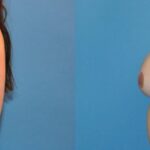 Breast Reduction #3 - Before and After