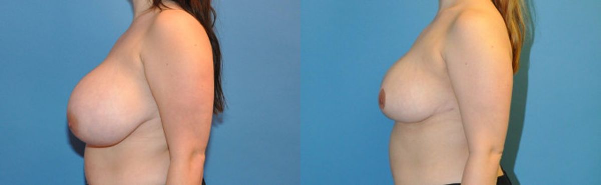 Breast Reduction #3 - Before and After