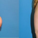 Breast Reduction #3 - Before and After