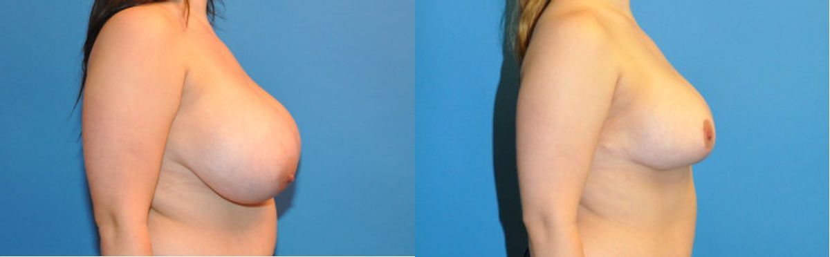 Breast Reduction #3 - Before and After