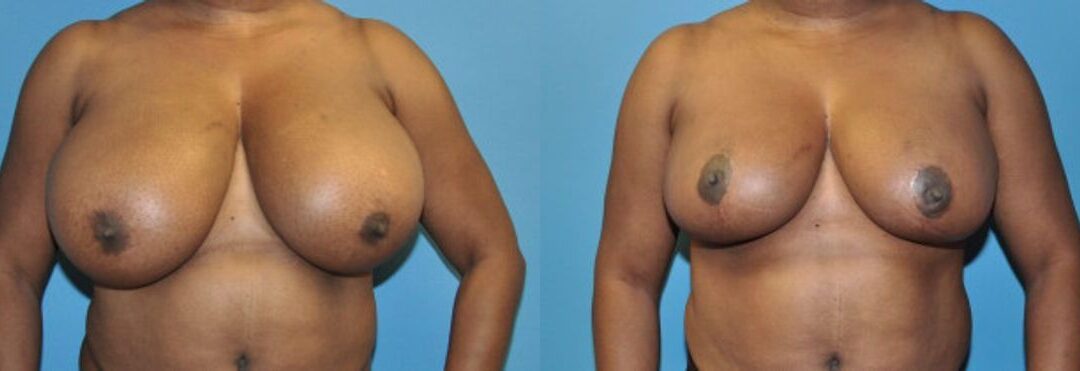 Breast Reduction #4