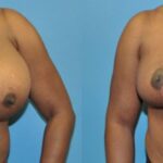 Breast Reduction #4 - Before and After