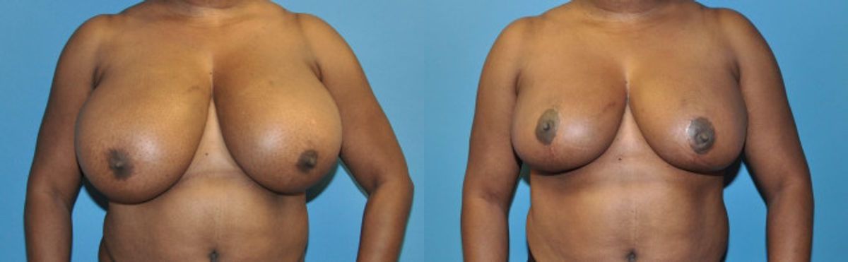 Breast Reduction #4 - Before and After