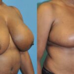 Breast Reduction #4 - Before and After