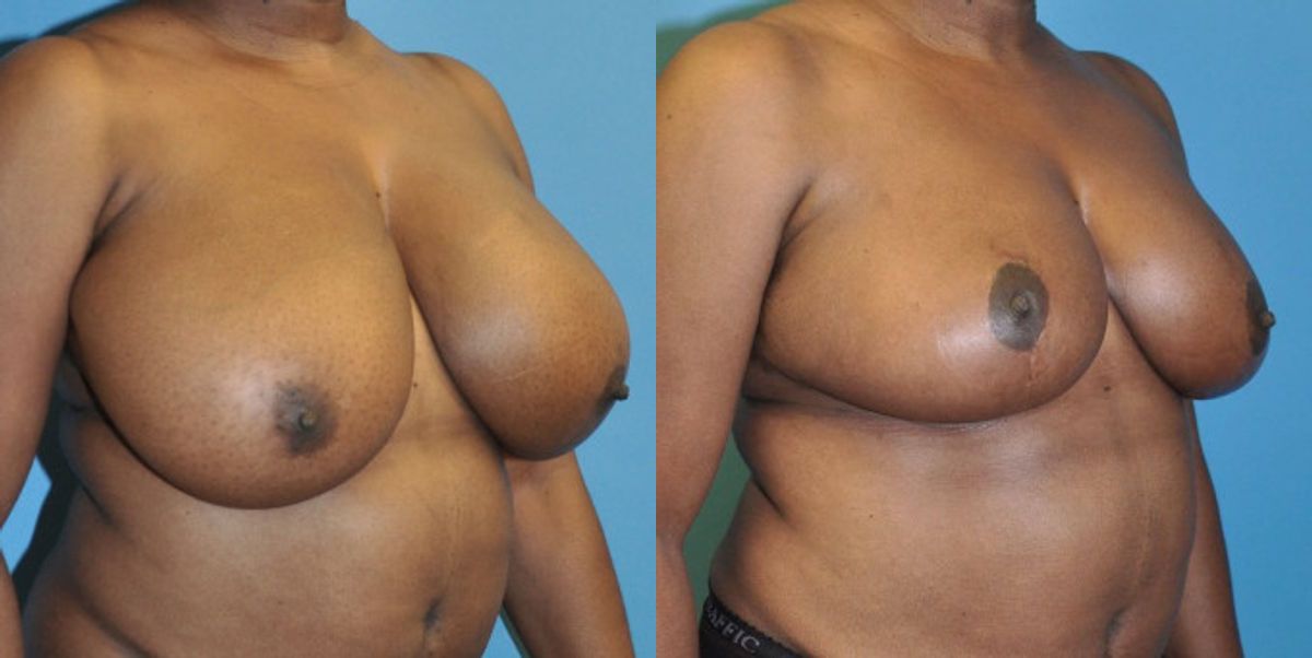 Breast Reduction #4 - Before and After