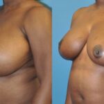 Breast Reduction #4 - Before and After
