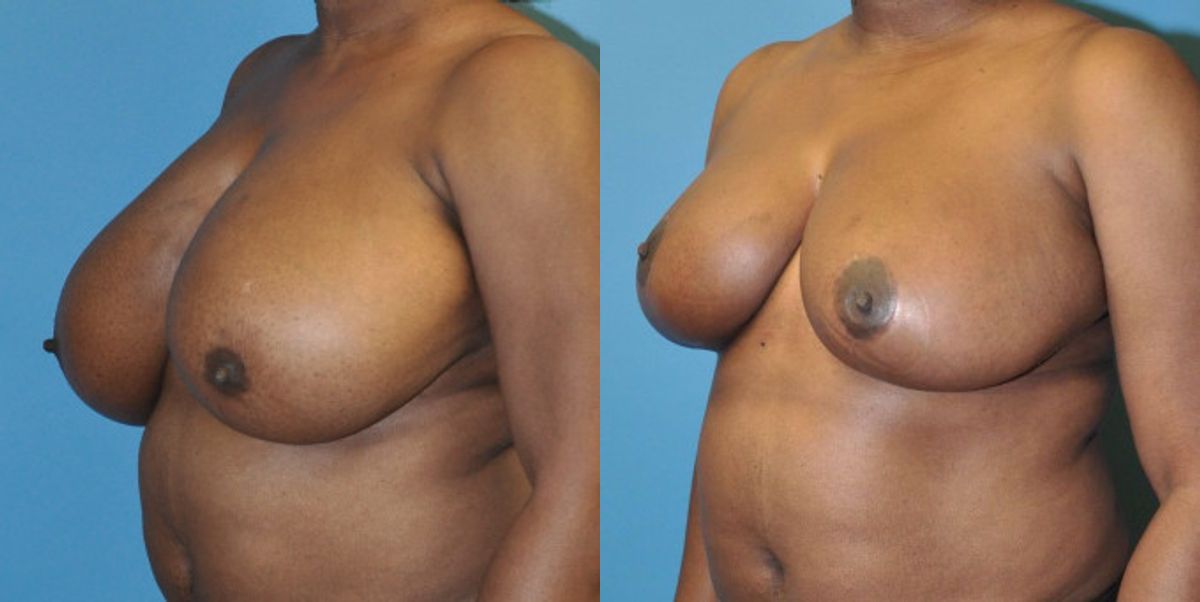 Breast Reduction #4 - Before and After