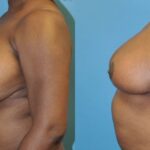 Breast Reduction #4 - Before and After