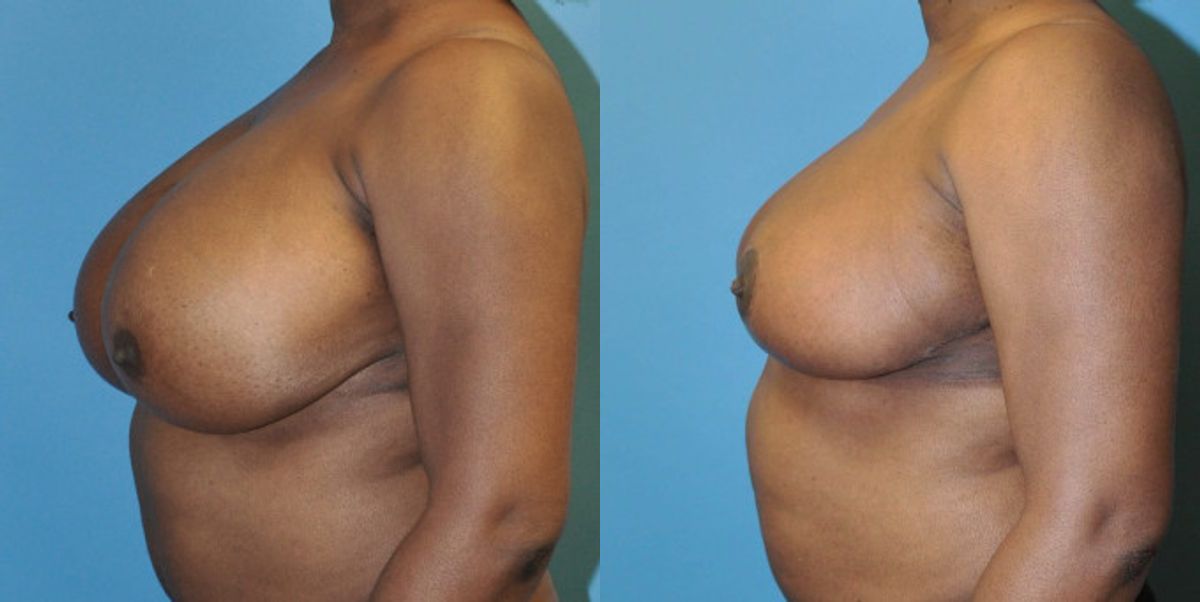 Breast Reduction #4 - Before and After