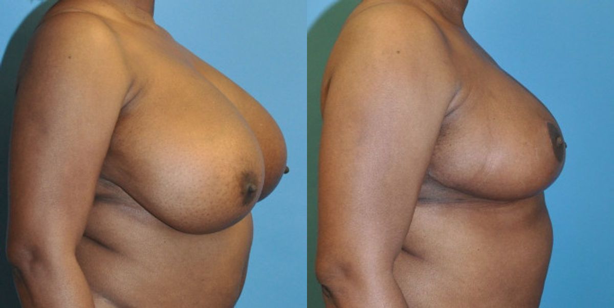 Breast Reduction #4 - Before and After