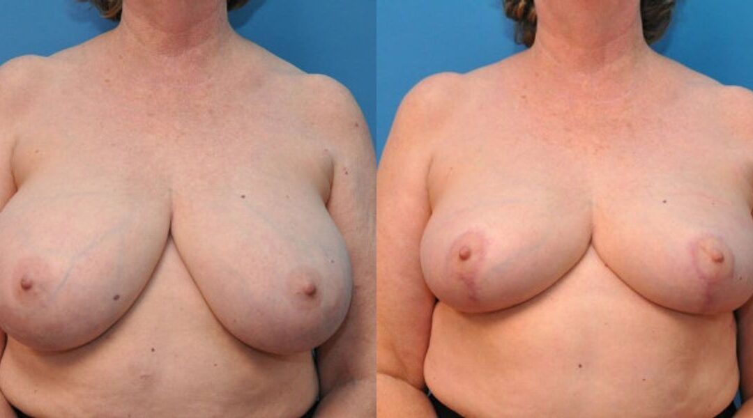 Breast Reduction #5