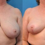 Breast Reduction #5 - Before and After