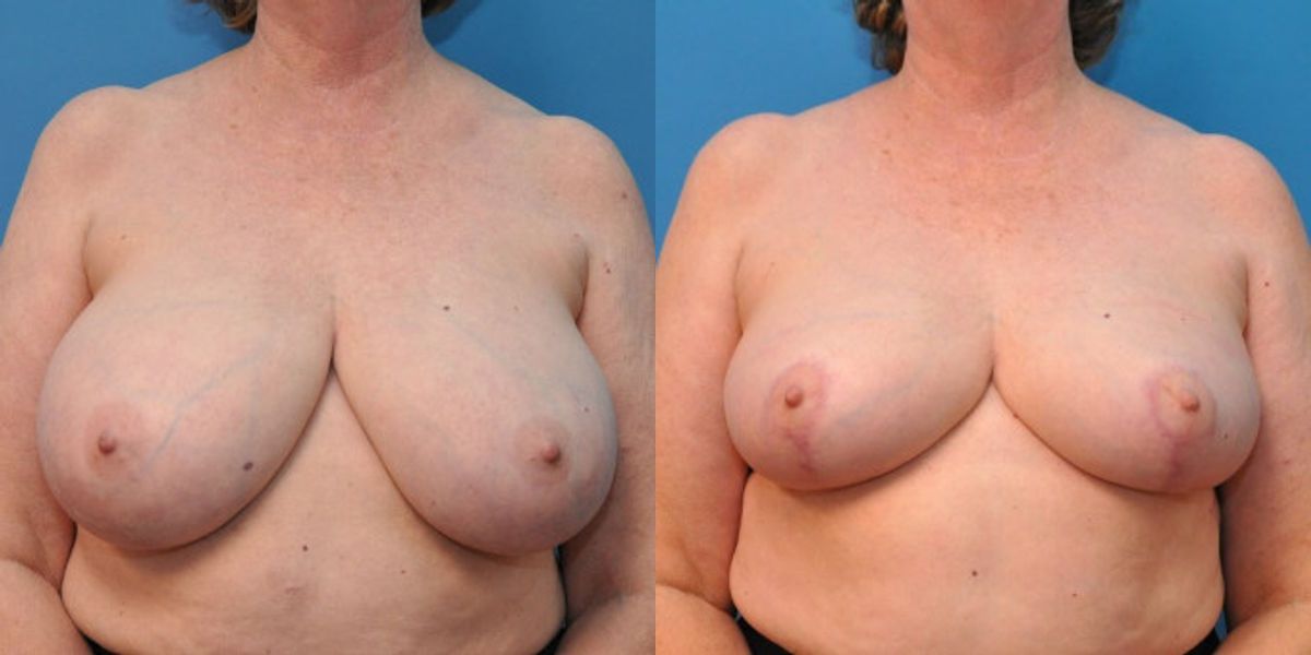 Breast Reduction #5 - Before and After