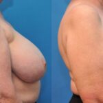 Breast Reduction #5 - Before and After