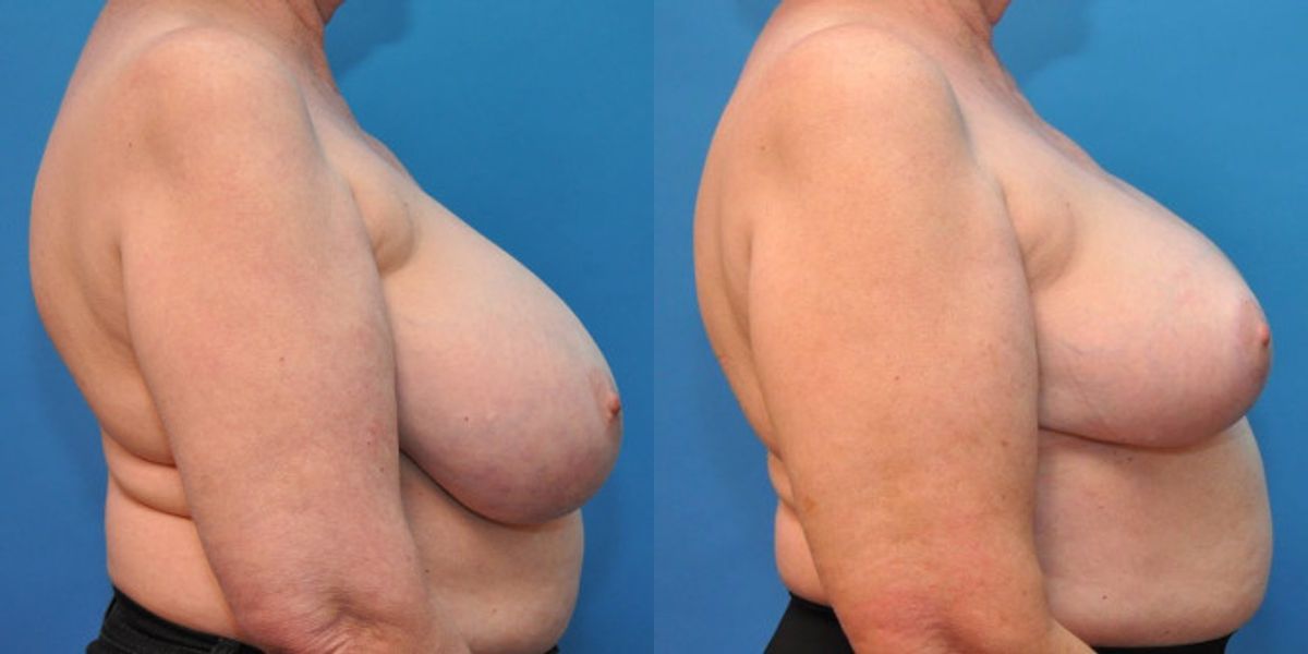 Breast Reduction #5 - Before and After