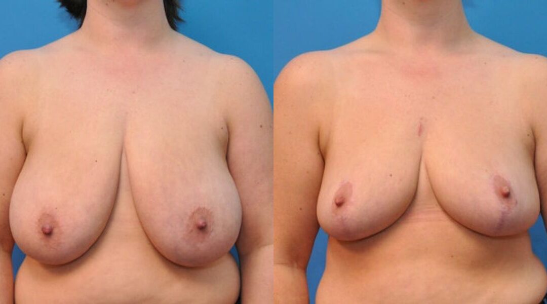 Breast Reduction #6