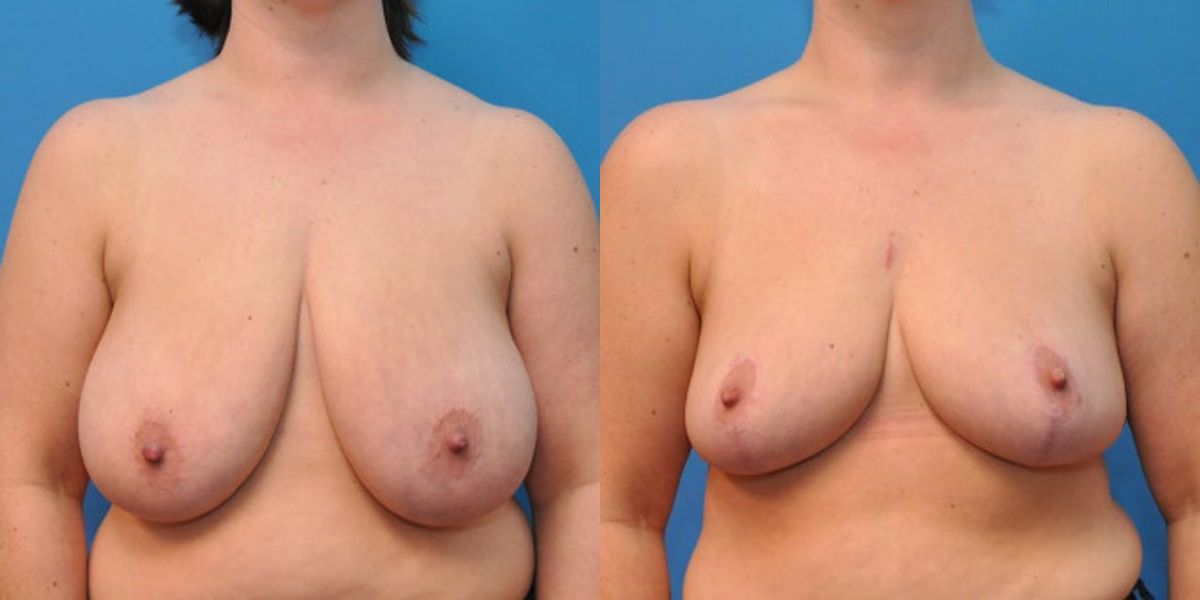 Breast Reduction #6 - Before and After