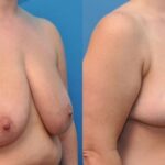 Breast Reduction #6 - Before and After